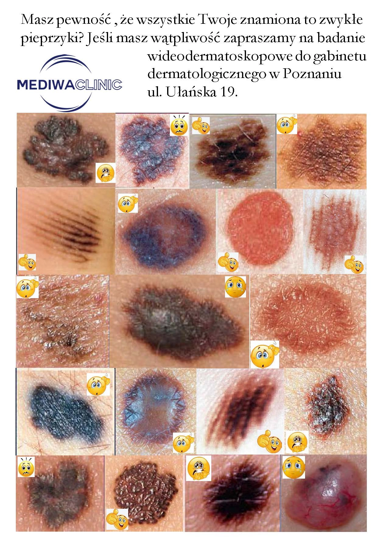 jak wygląda czerniak