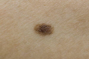 duży pieprzyk na ciele