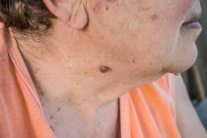 pieprzyk na szyi starszej kobiety