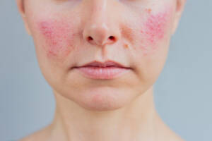rumień na twarzy